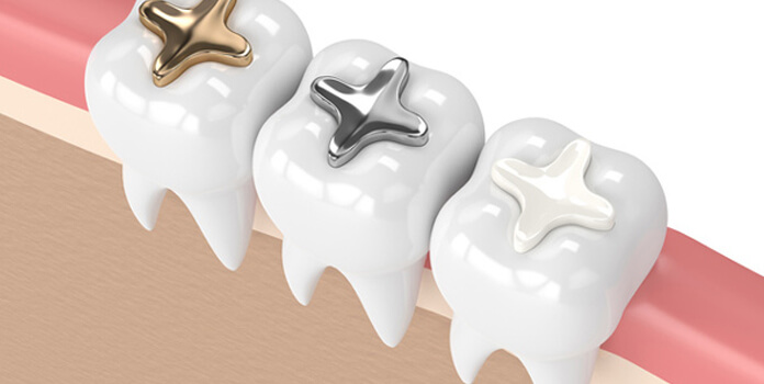 Dental Fillings Dental Fillings