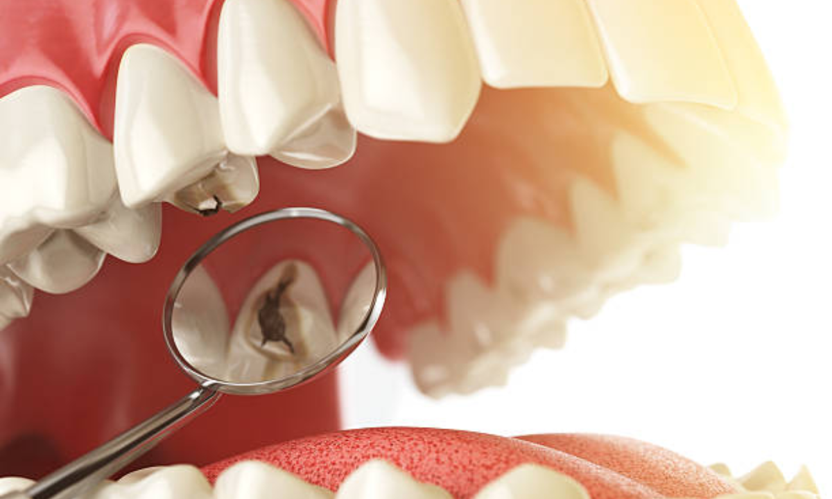Dental Fillings Dental Fillings