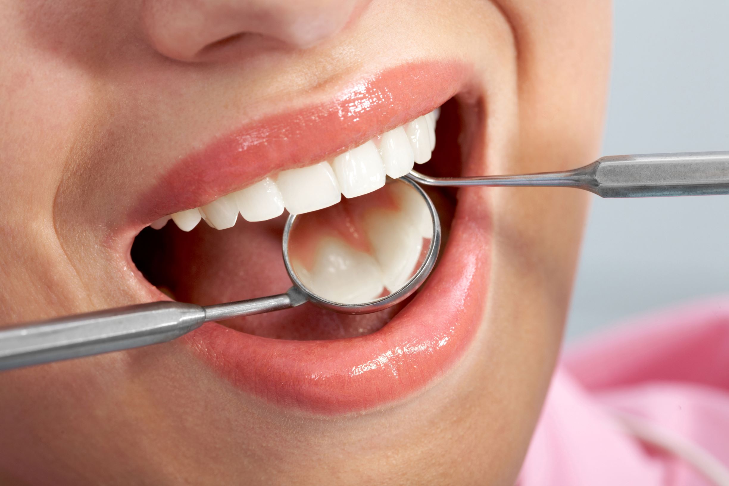 Dental Fillings Dental Fillings