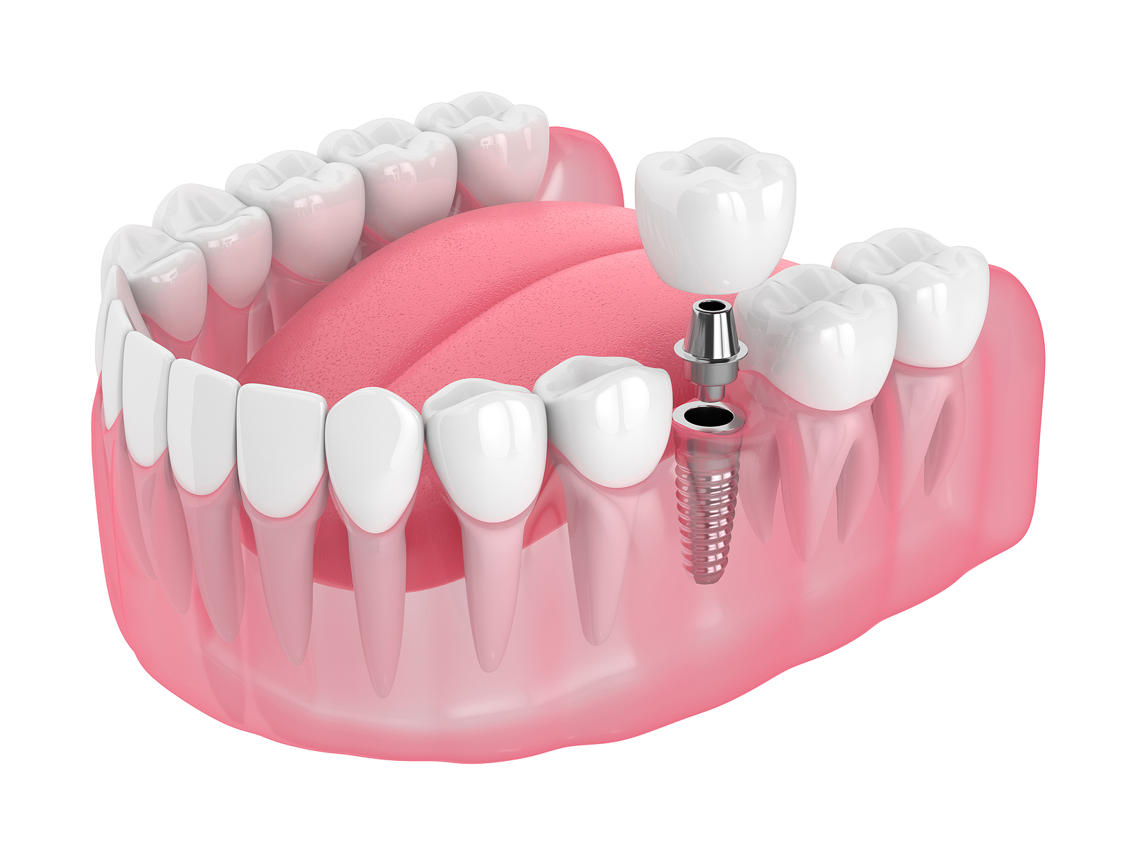 Dental Implants Dental Implants