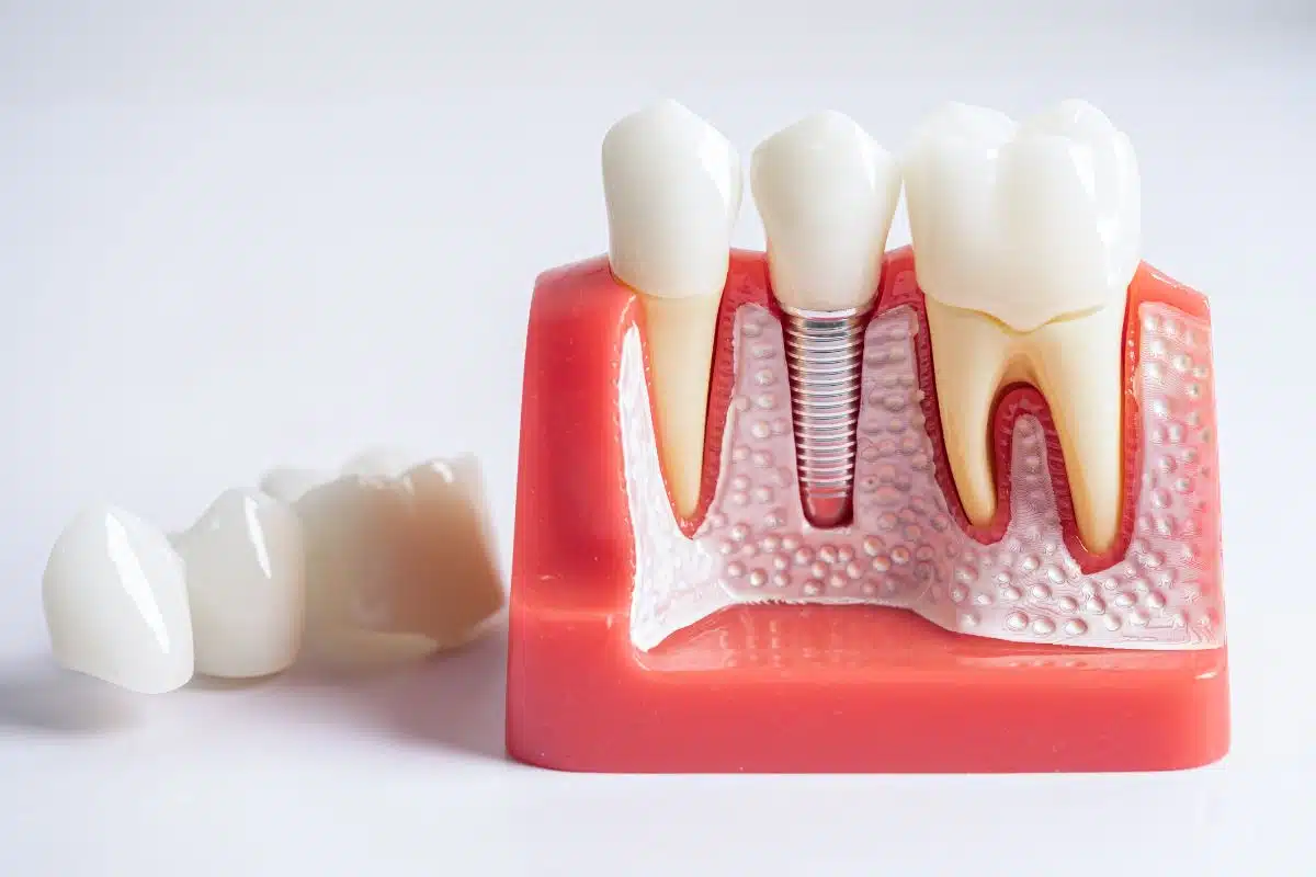 Dental Implants Dental Implants