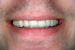 Sedation Dentistry Sedation Dentistry