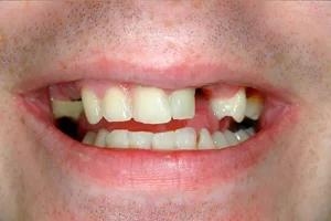 Sedation Dentistry Sedation Dentistry