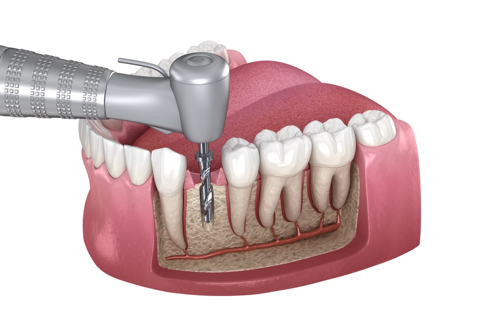 Root Canal Treatment Root Canal Treatment