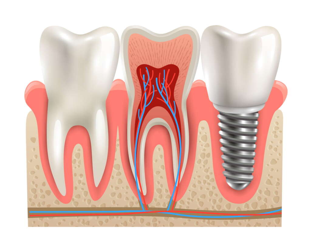 Root Canal Treatment Root Canal Treatment