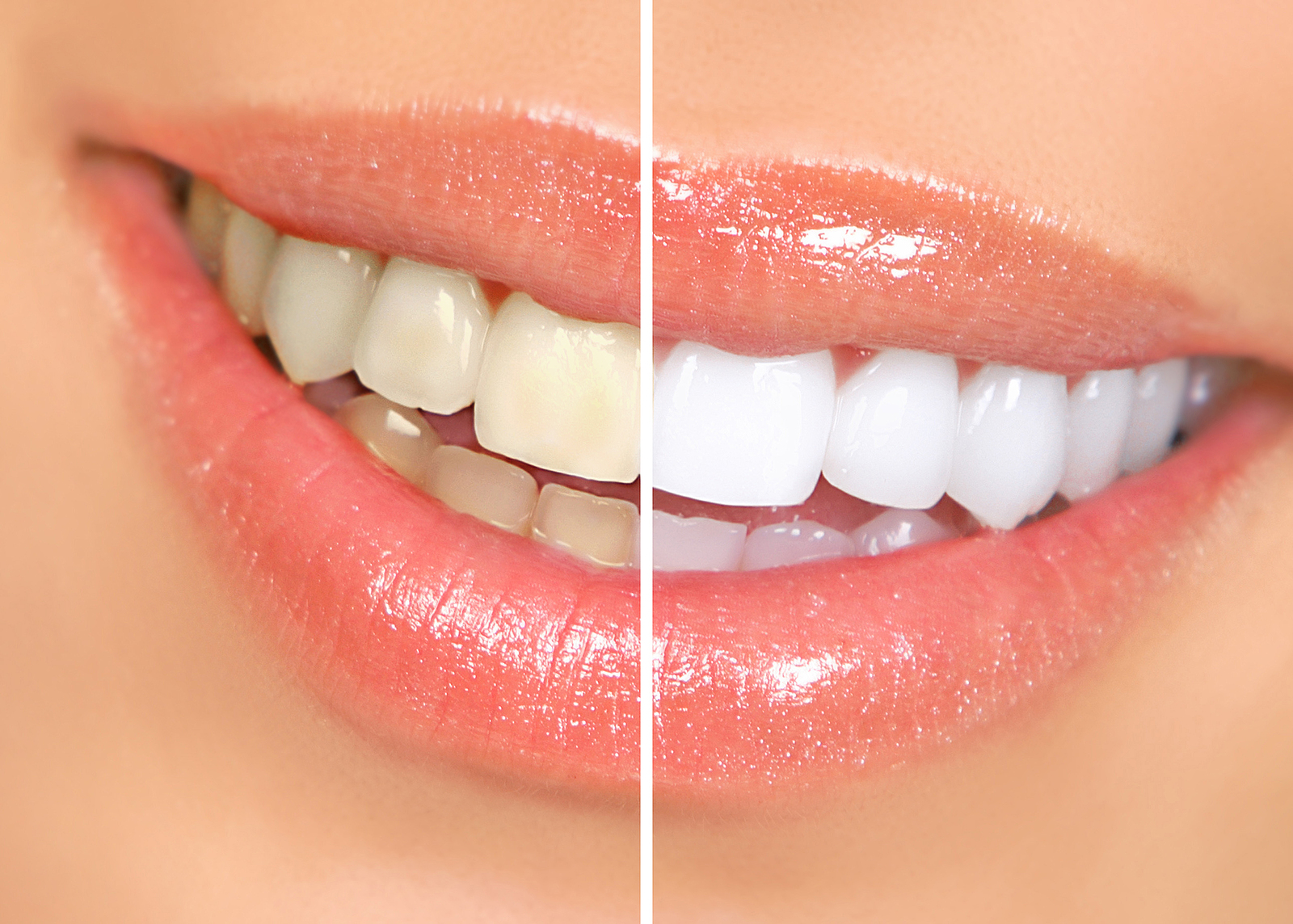 Teeth Whitening Teeth Whitening