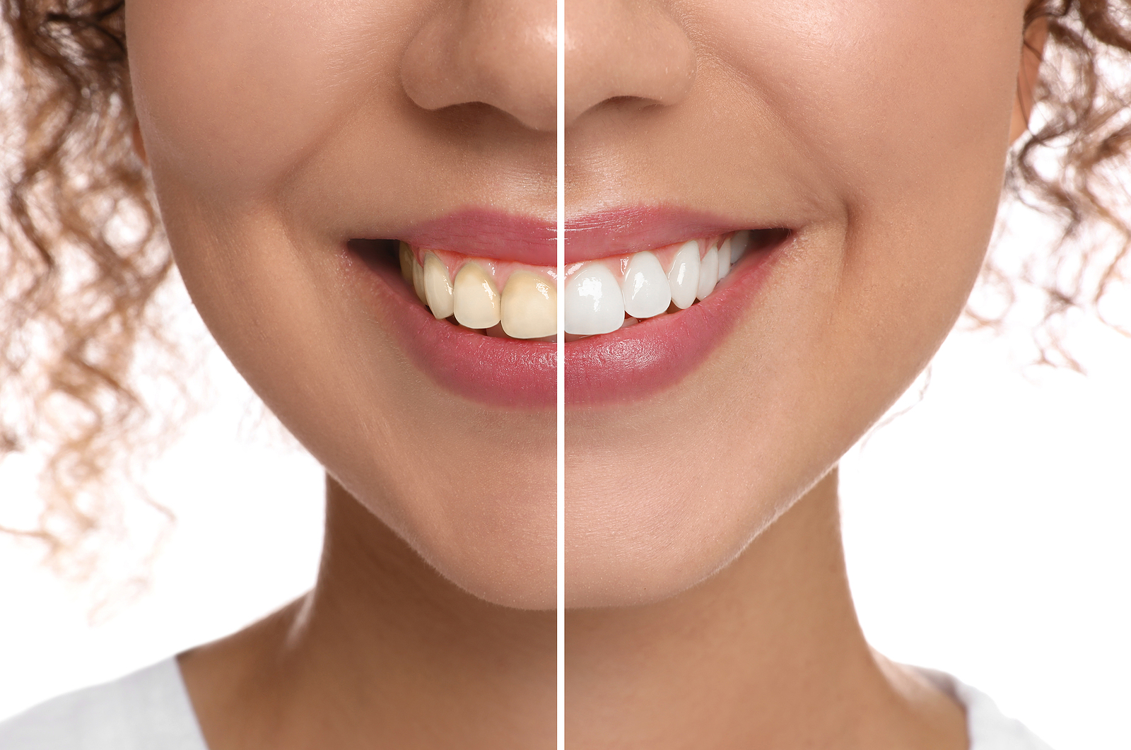 Teeth Whitening Teeth Whitening