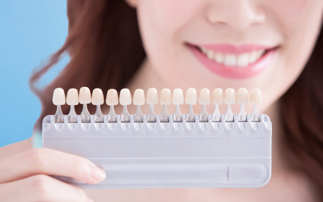Veneers Veneers