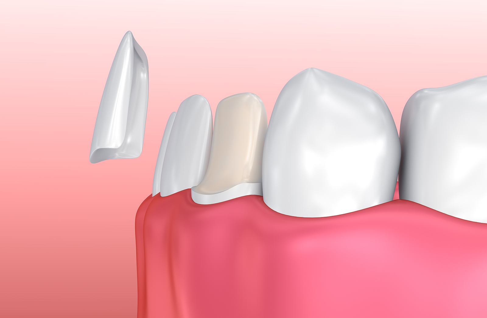 Veneers Veneers