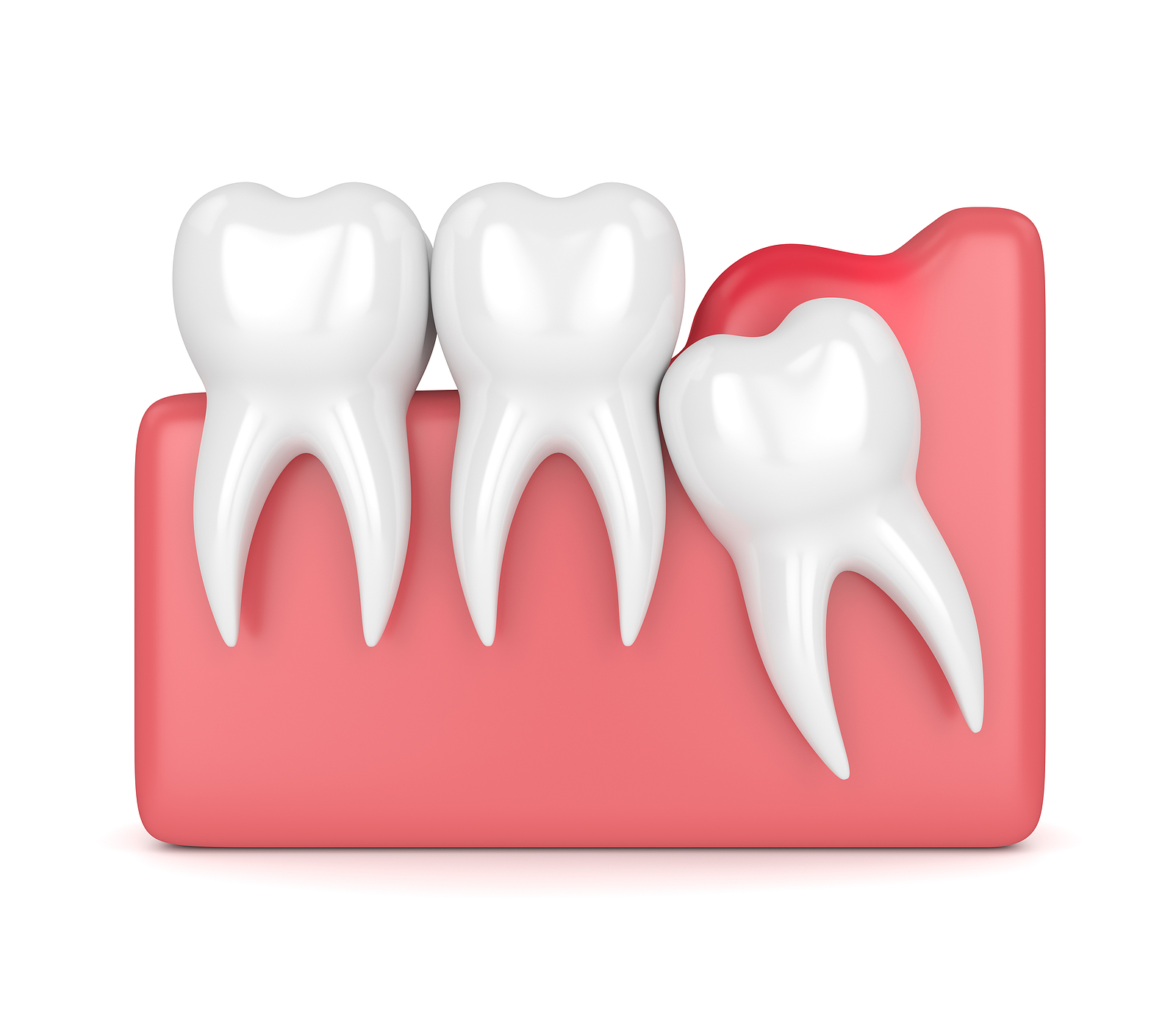 Wisdom Teeth Wisdom Teeth